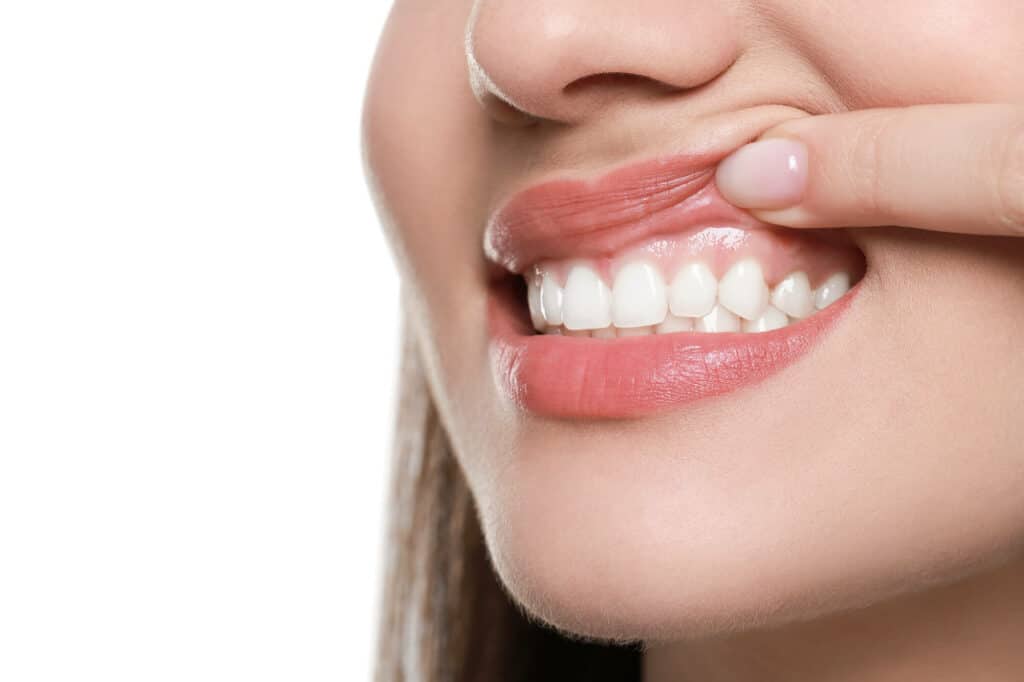 Healthy Gums after getting Holistic Treatment for Periodontal Disease