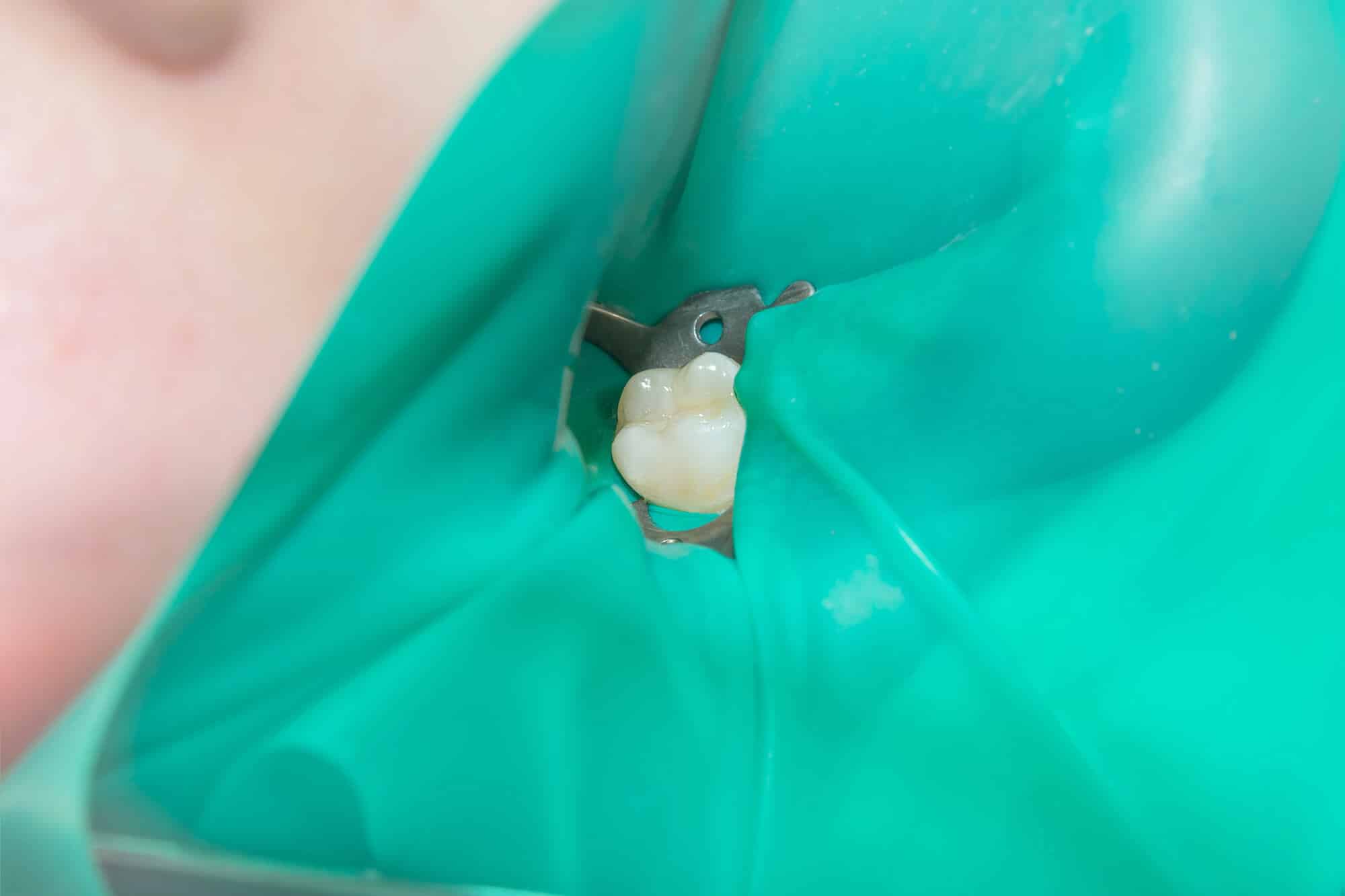Tooth isolated with a rubber dam during mercury filling removal