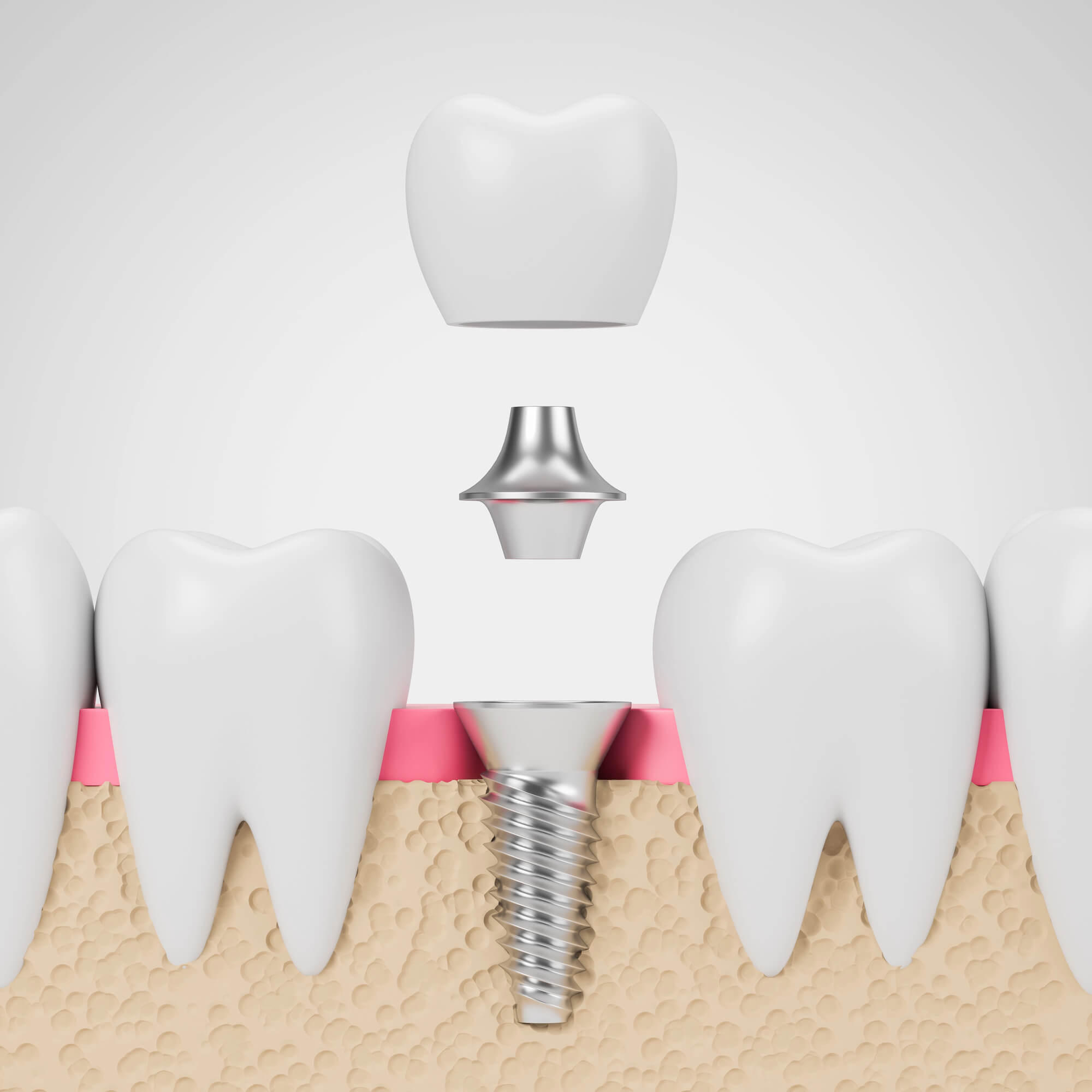 Illustration of a metal-free dental implant with abutment and crown