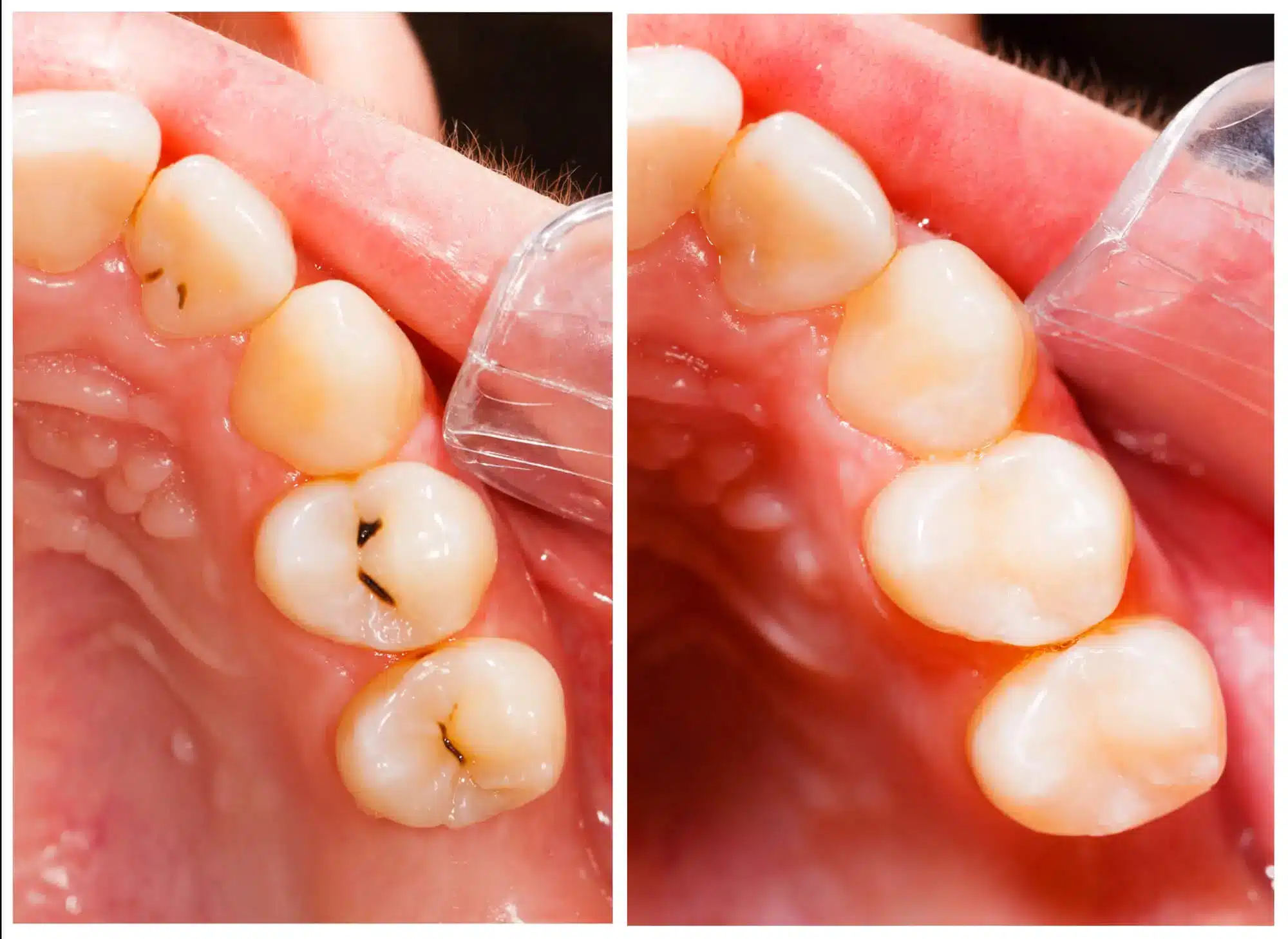 Before and after tooth-colored composite fillings replacing decayed areas