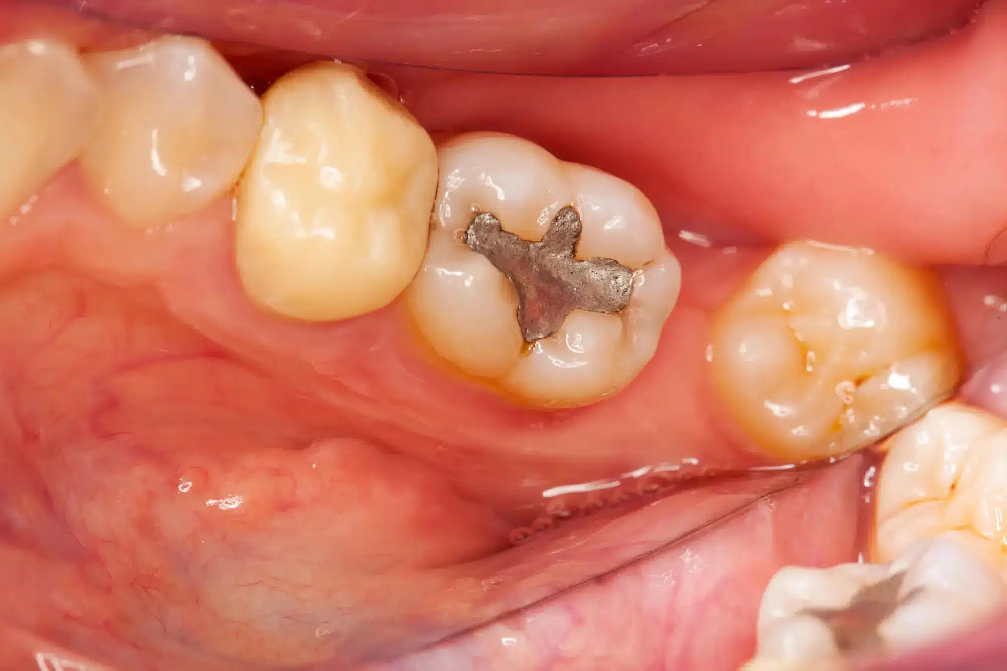 Tooth with an old silver amalgam filling