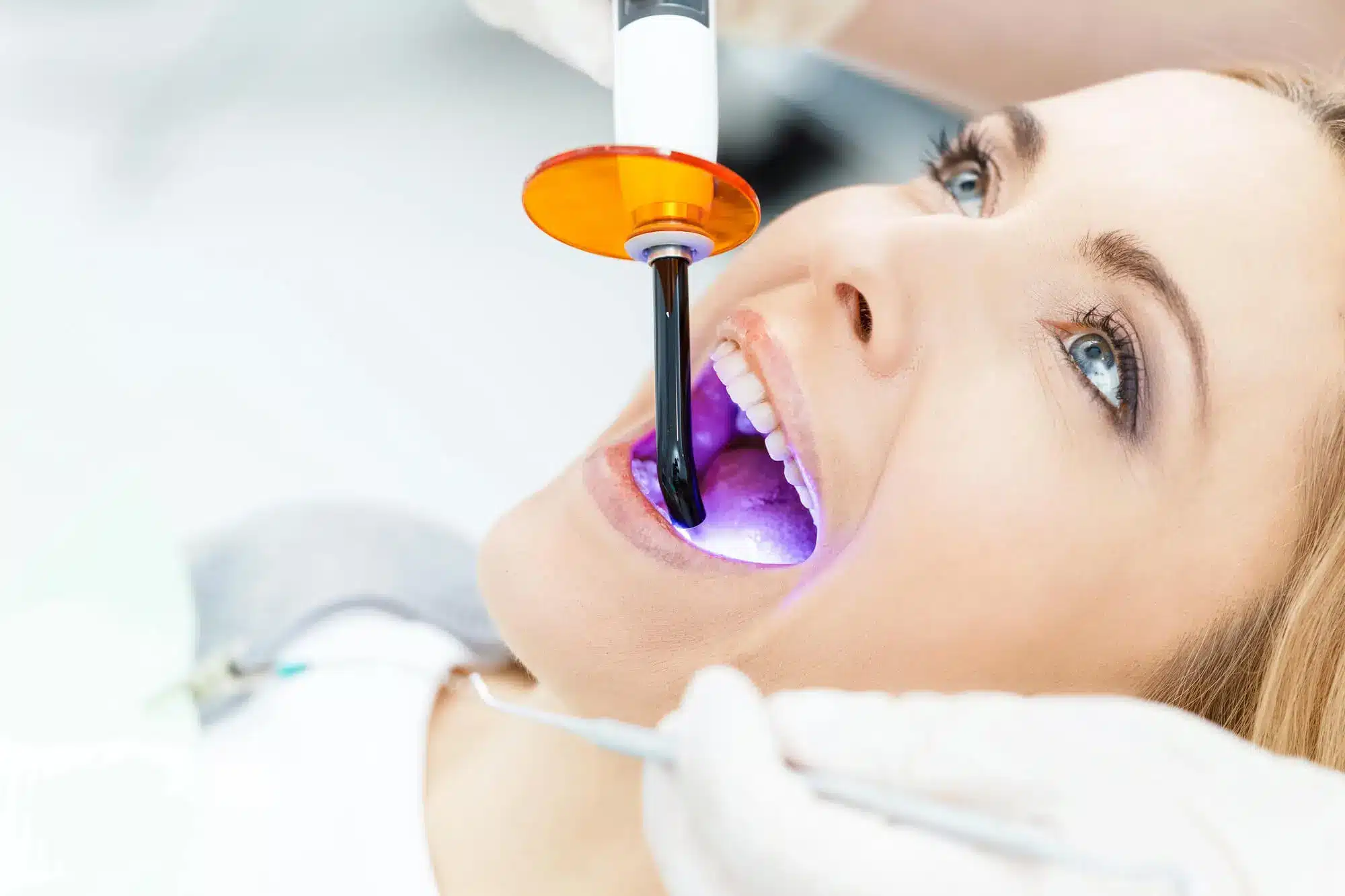 Teeth whitening treatment with a light activating the whitening gel