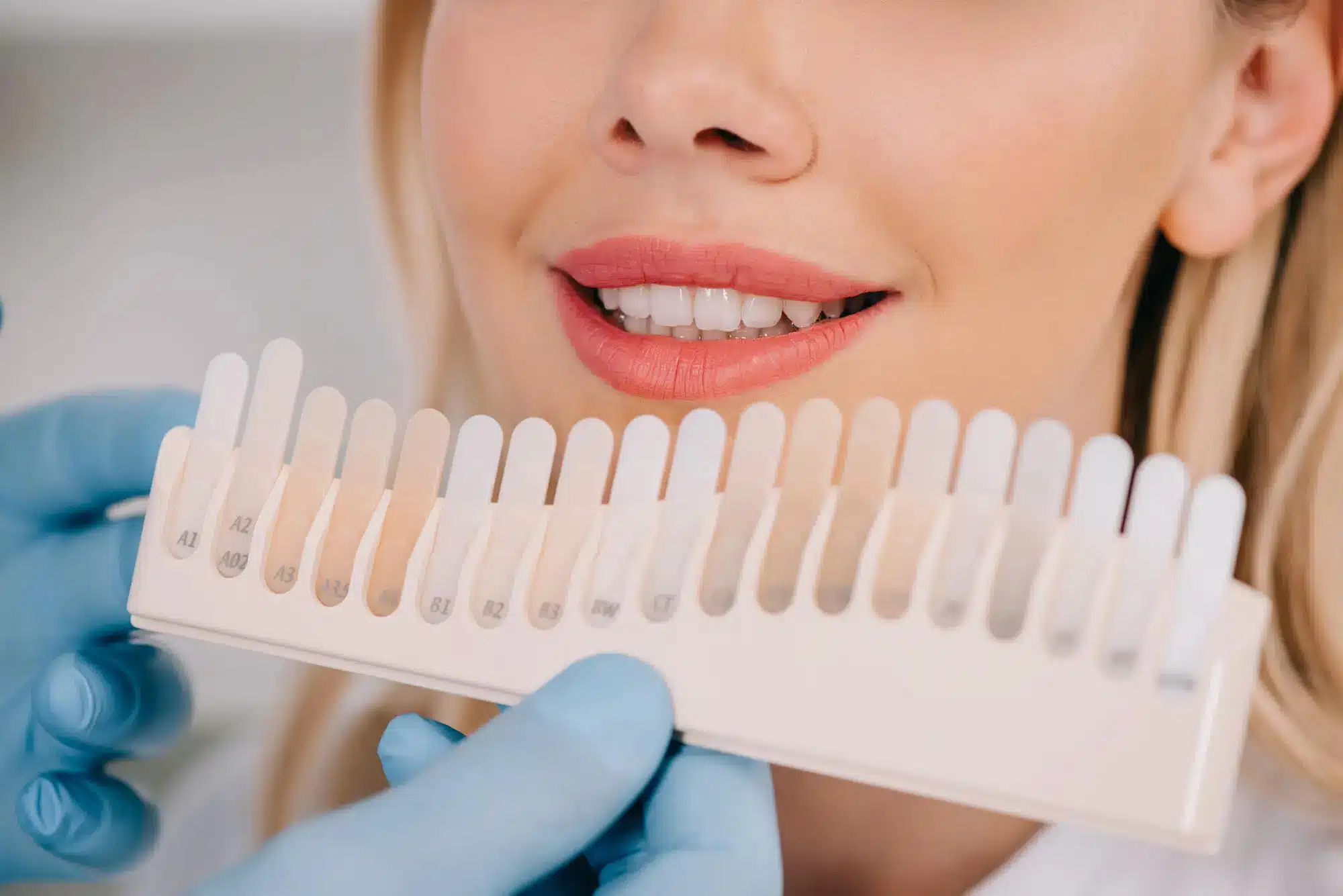 Tooth shade guide used to check whitening results