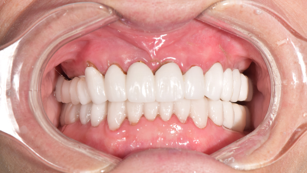 1. After Photo: White, Even Teeth Veneers