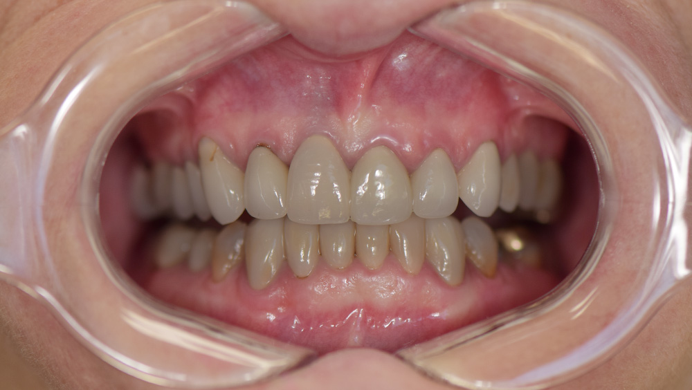 1. Before Photo: Yellow Teeth