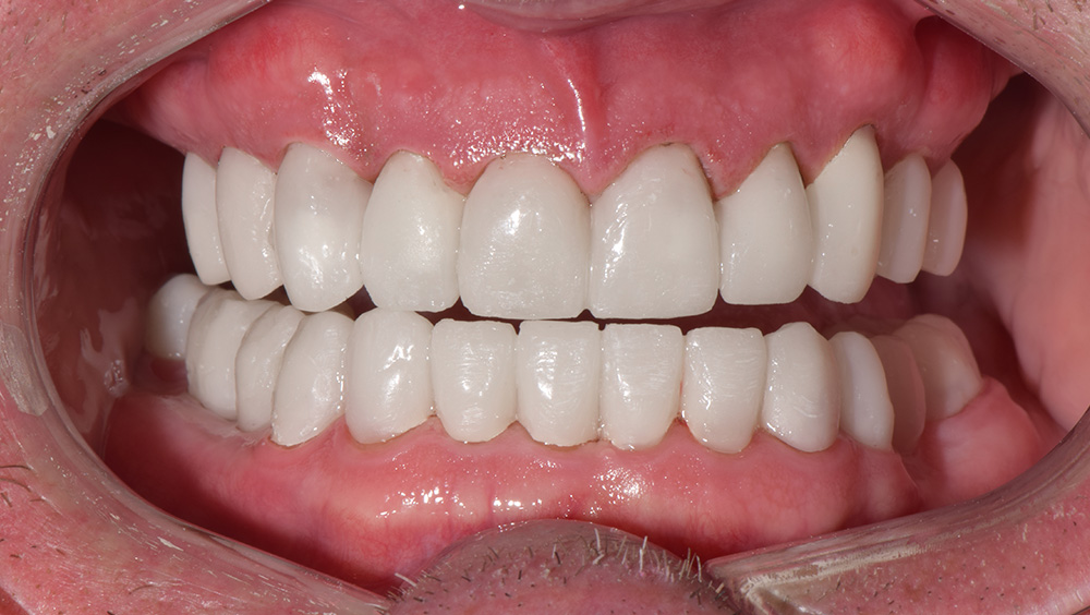 2. After Photo: Even Smile