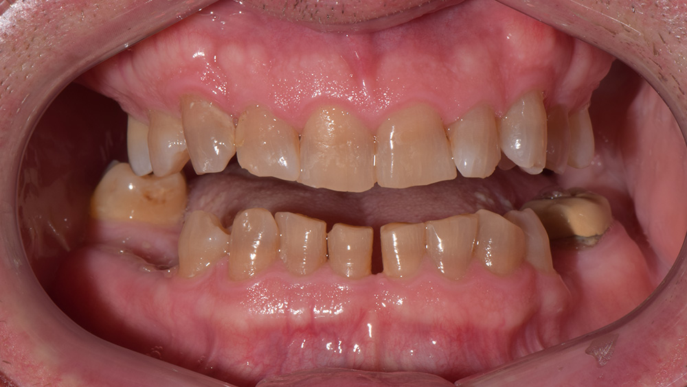 2. Before Photo: Rotten, Yellow Teeth