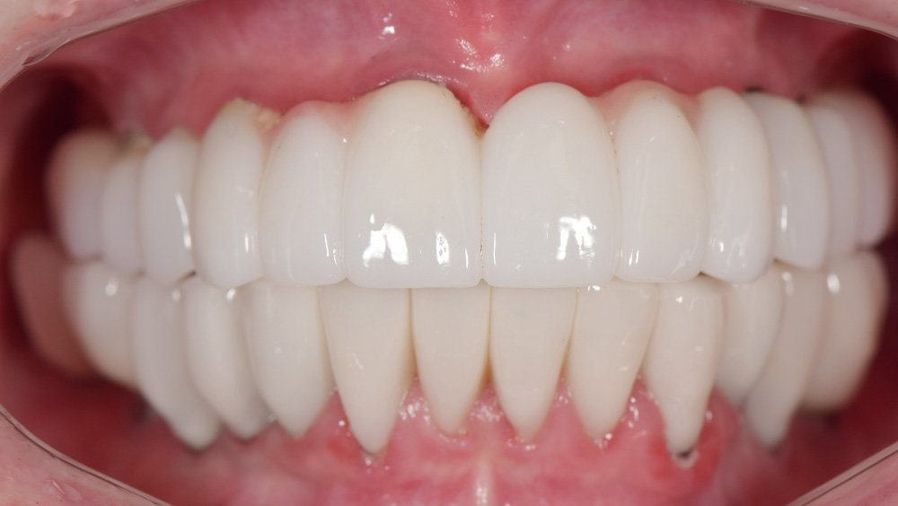 3. After Photo: Smile with New Veneers