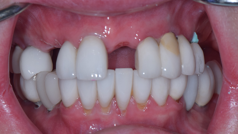 3. Before Photo: Missing Teeth