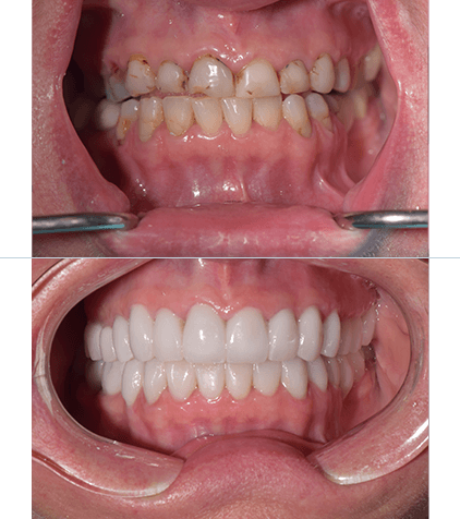 Before and After dental cleaning, gum contouring and dental veneers